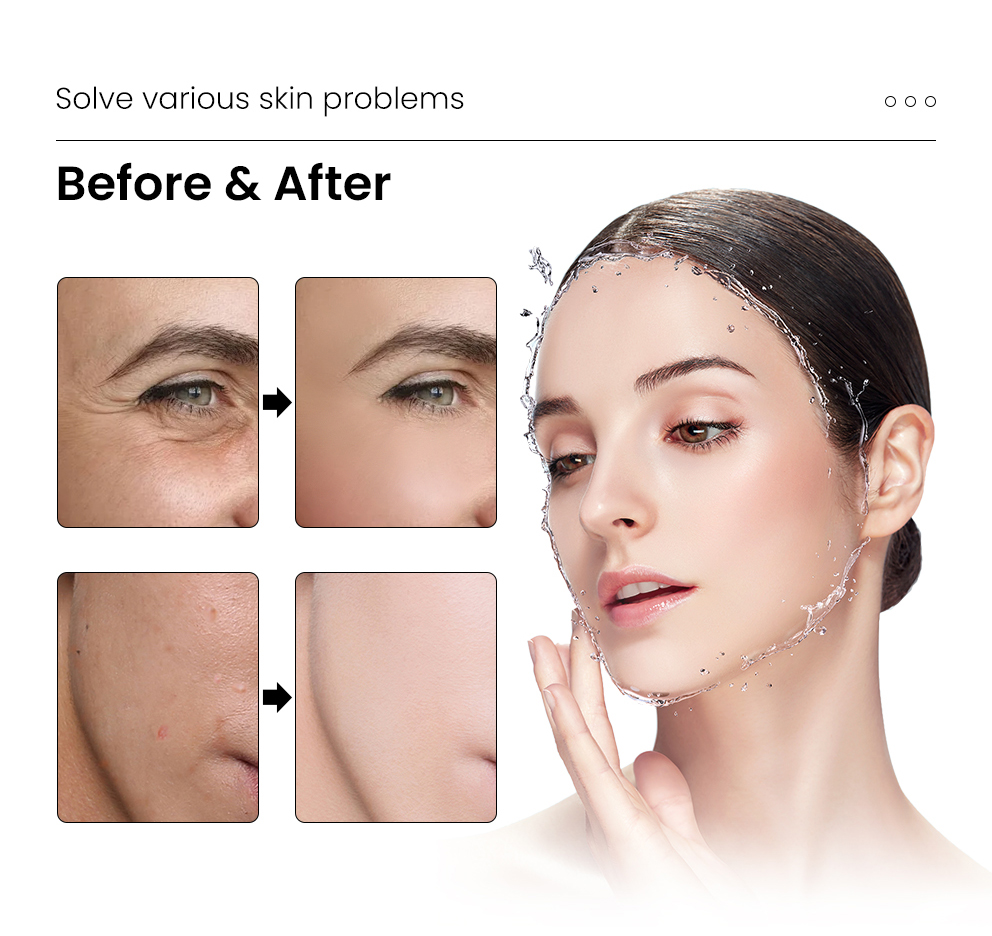 Skinbooster de ácido hialurônico 4D